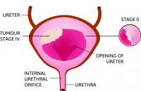 Cryoblation Breast Cancer Logo